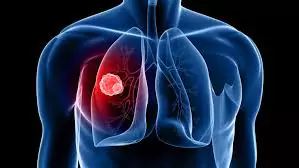 Lung Cancer Innovations