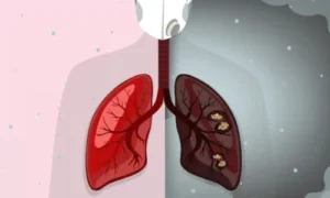 Air Pollution Affect the Lungs