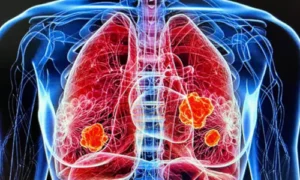 Biologic Therapies