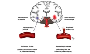 Cerebrovascular Disorders