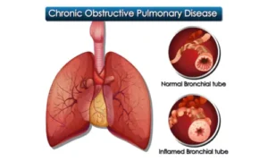 Chronic Obstructive Pulmonary Disorder