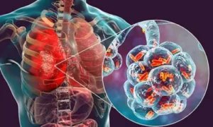 Pneumonia
